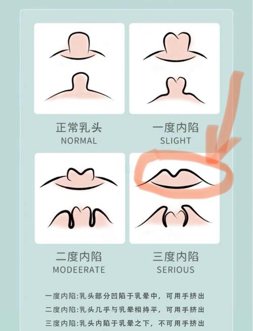 孕期乳头内陷能通过吸乳器改善吗？吸乳会对胎儿有影响吗？-第1张图片-郑州医学网