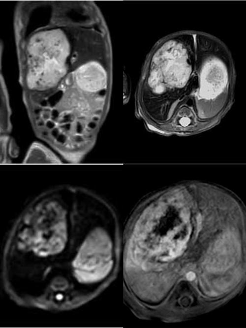新生儿10天就做核磁共振，对宝宝身体会有影响吗？-第2张图片-郑州医学网