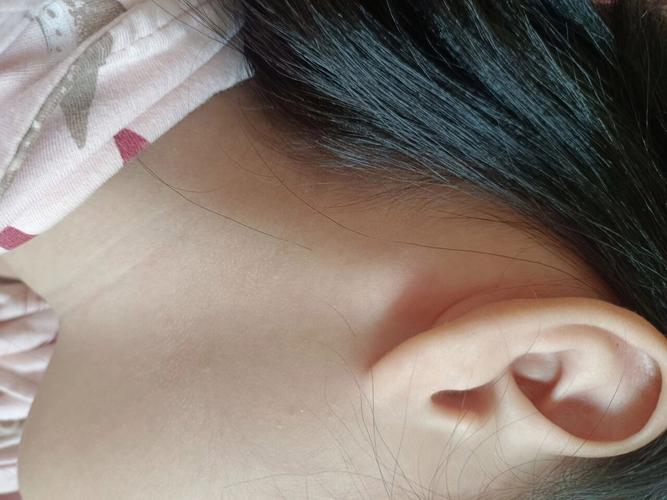 新生儿耳朵后面出现疙瘩，是正常生理现象还是需要警惕的异常信号？-第2张图片-郑州医学网