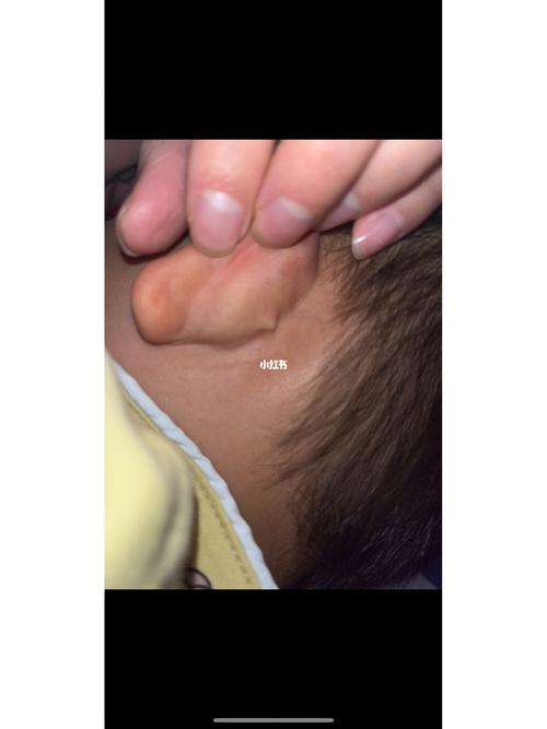 新生儿耳朵后面出现疙瘩，是正常生理现象还是需要警惕的异常信号？-第1张图片-郑州医学网