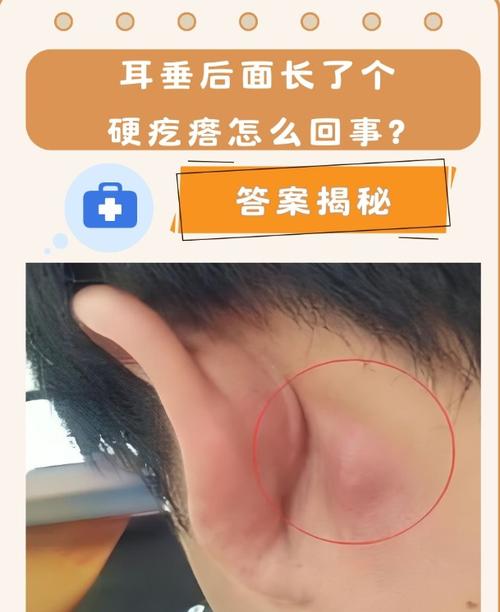 新生儿耳朵后面出现疙瘩，是正常生理现象还是需要警惕的异常信号？-第3张图片-郑州医学网