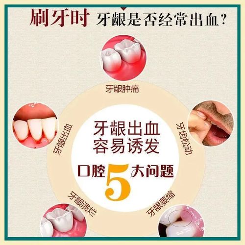 孕期牙龈出血能吃什么药？安全有效的药物有哪些？-第3张图片-郑州医学网