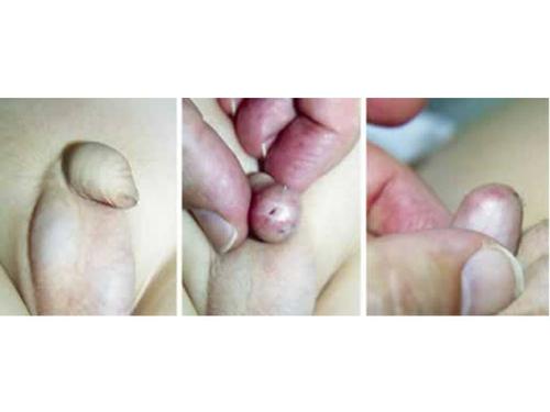 儿童小鸡（生殖器）出现疙瘩是何原因？是否需要紧急就医？附图分析是否正常？-第2张图片-郑州医学网