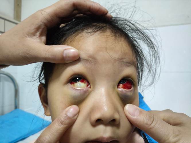 儿童眼睛充血是上火还是疾病信号？家长该如何正确判断和处理？-第1张图片-郑州医学网