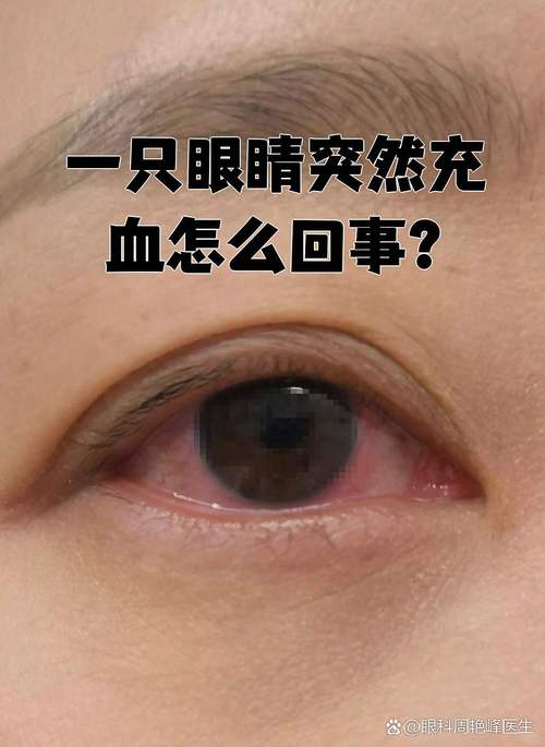 儿童眼睛充血是上火还是疾病信号？家长该如何正确判断和处理？-第2张图片-郑州医学网
