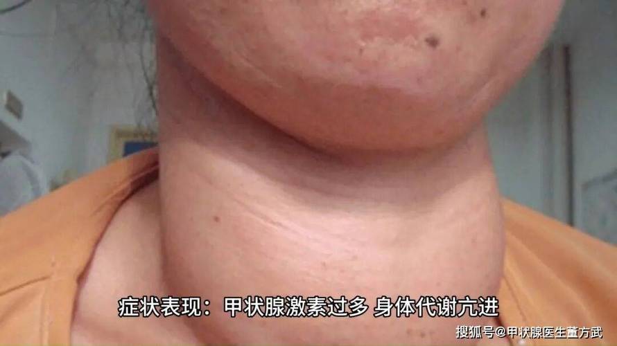 孕期甲亢若不服药，会对胎儿及孕妇自身造成哪些不可逆的健康风险？-第3张图片-郑州医学网