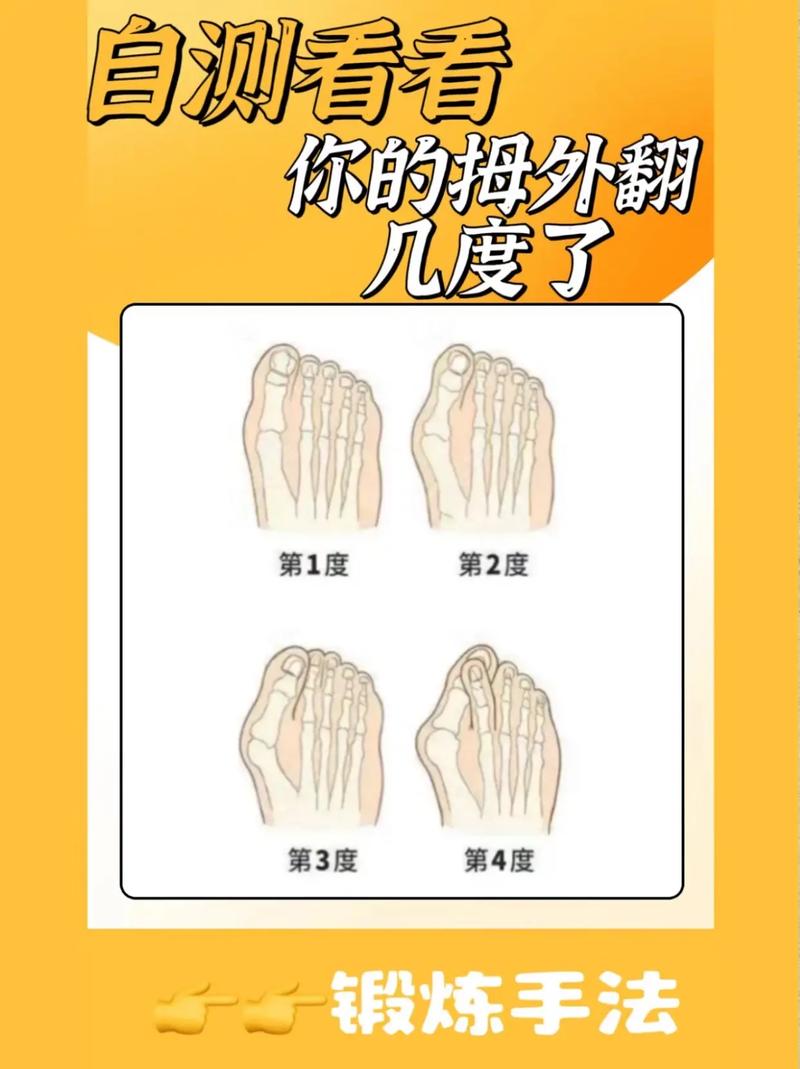 儿童拇指外翻治疗的最佳方法是什么？需要手术吗？-第1张图片-郑州医学网