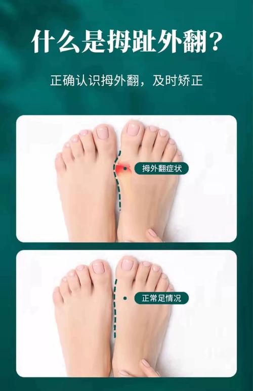 儿童拇指外翻治疗的最佳方法是什么？需要手术吗？-第3张图片-郑州医学网