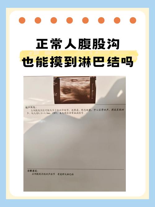 孕期腹股沟淋巴结肿大是正常生理变化还是疾病信号？需警惕哪些潜在风险？-第1张图片-郑州医学网