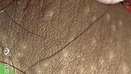 孕期下体长小疙瘩奇痒是何原因？对胎儿有影响吗？该怎么处理？-第1张图片-郑州医学网