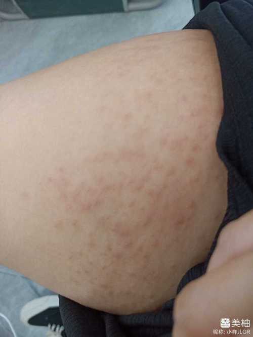 孕期下体长小疙瘩奇痒是何原因？对胎儿有影响吗？该怎么处理？-第2张图片-郑州医学网