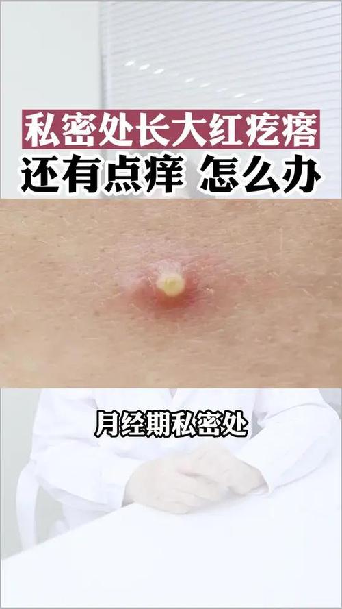 孕期下体长小疙瘩奇痒是何原因？对胎儿有影响吗？该怎么处理？-第3张图片-郑州医学网