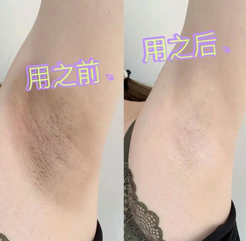 孕期腋窝发黑是激素变化还是身体异常信号？需关注哪些健康问题？-第3张图片-郑州医学网