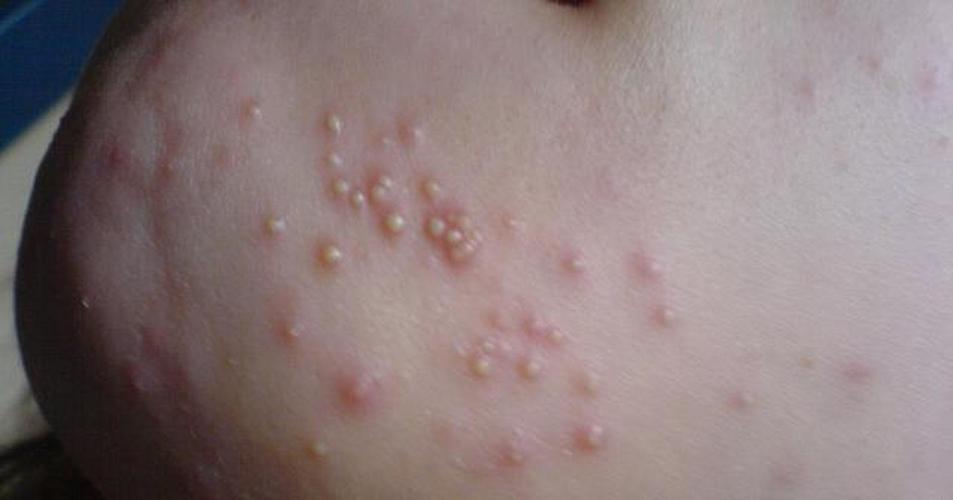 新生儿脓疱疮治疗的关键措施有哪些？如何避免传染和护理？-第2张图片-郑州医学网