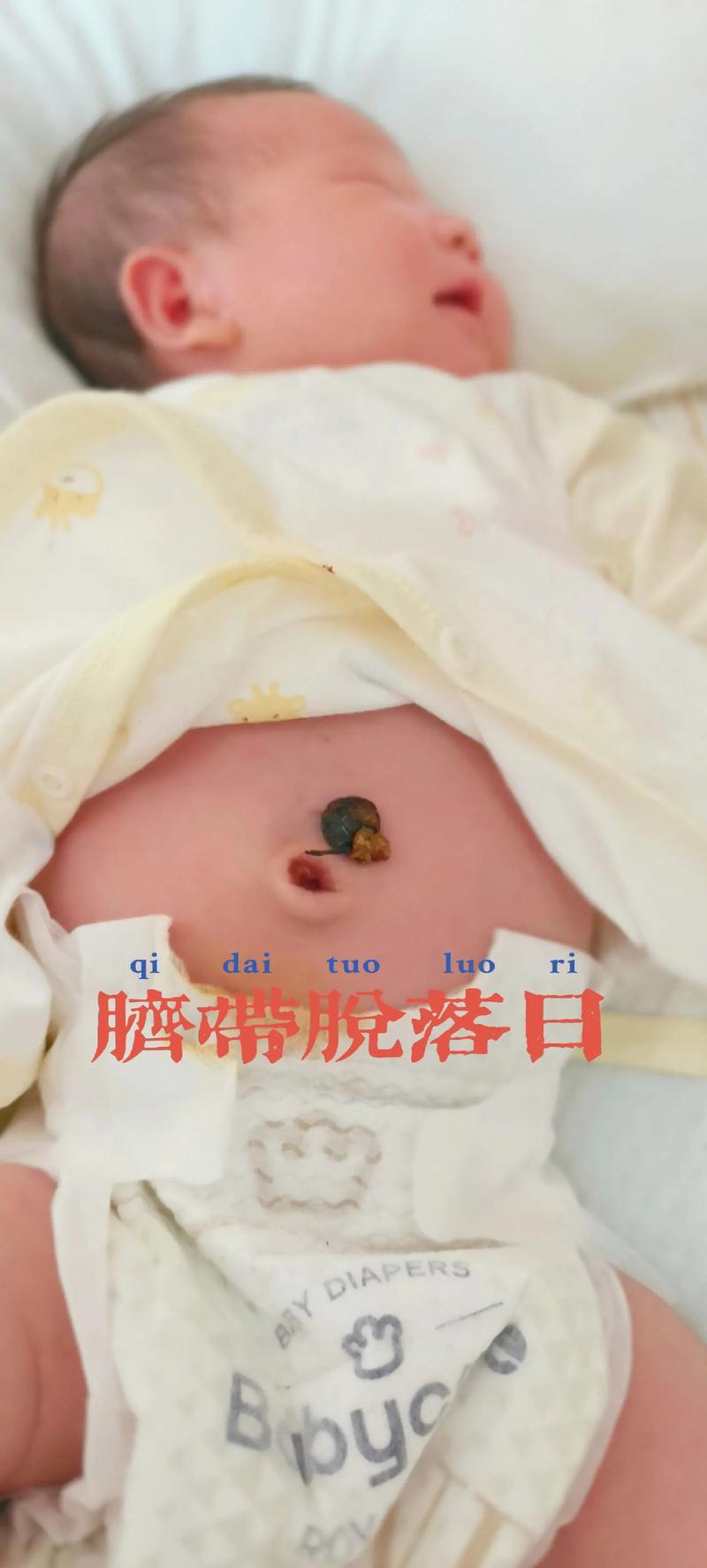 新生儿脐带脱落需要多长时间？脱落前后家长该如何正确护理？-第2张图片-郑州医学网