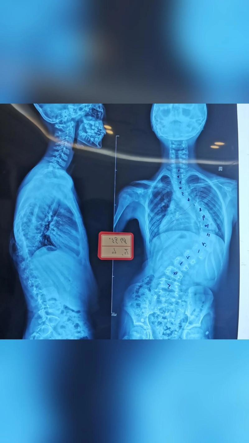 儿童后背脊柱突出图片是脊柱侧弯吗？需要警惕哪些异常信号？-第2张图片-郑州医学网