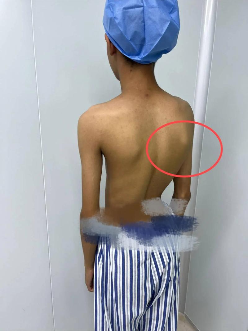 儿童后背脊柱突出图片是脊柱侧弯吗？需要警惕哪些异常信号？-第1张图片-郑州医学网