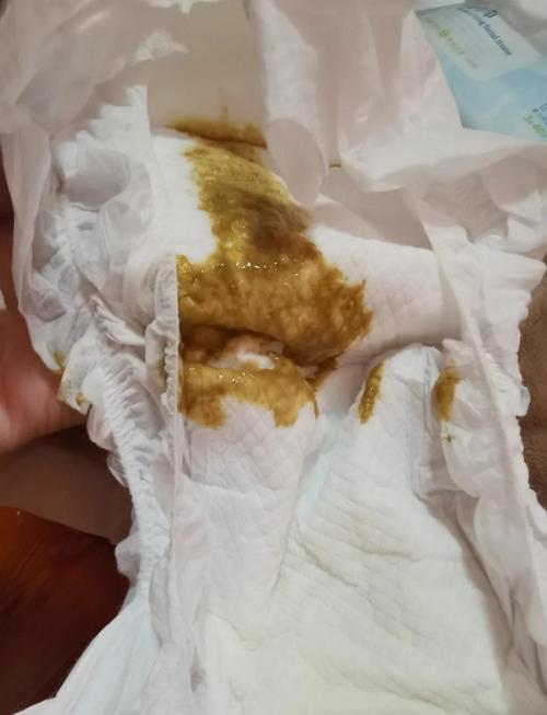 半个月新生儿拉肚子怎么办？需要马上就医还是先观察护理？-第2张图片-郑州医学网