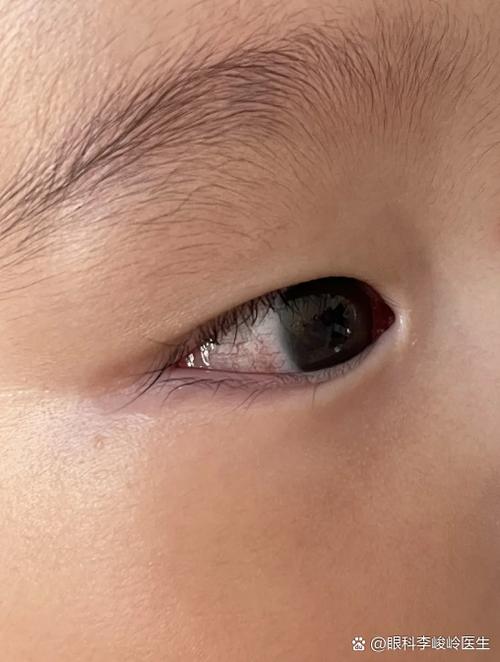 新生儿瞳孔周围出现一圈环状物是正常生理现象还是异常信号?-第3张图片-郑州医学网 新生儿瞳孔周围出现一圈环状物是正常生理现象还是异常信号?-第3张图片-郑州医学网