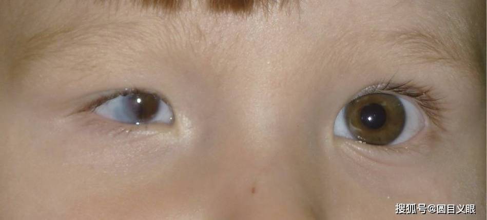 新生儿瞳孔周围出现一圈环状物是正常生理现象还是异常信号?-第2张图片-郑州医学网 新生儿瞳孔周围出现一圈环状物是正常生理现象还是异常信号?-第2张图片-郑州医学网