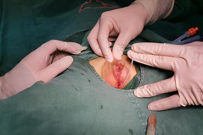 新生儿尿道口下裂手术最佳时机是什么？术后护理要注意哪些问题？-第1张图片-郑州医学网