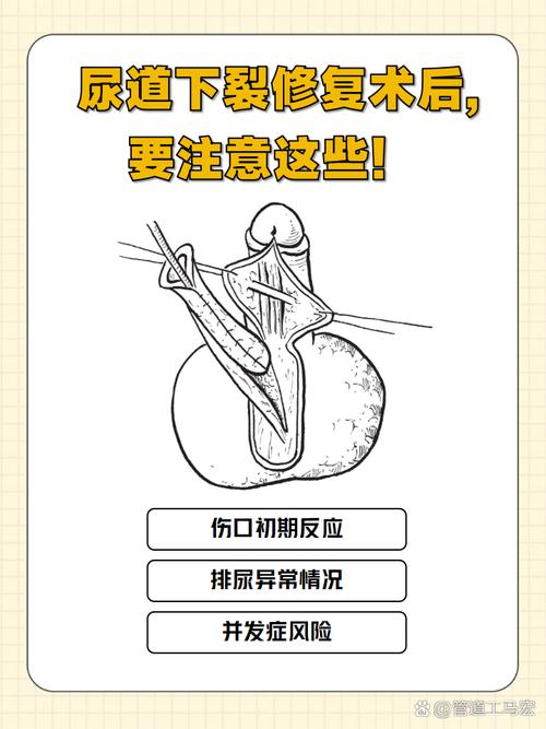 新生儿尿道口下裂手术最佳时机是什么？术后护理要注意哪些问题？-第3张图片-郑州医学网
