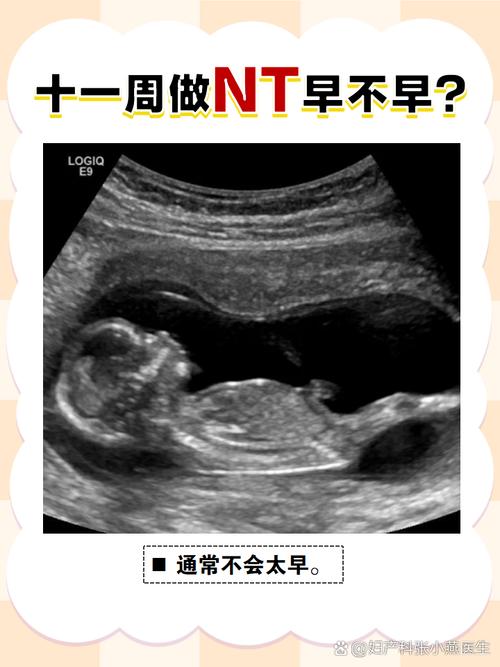孕期11周该做哪些检查？NT检查和唐筛有必要都做吗？-第1张图片-郑州医学网