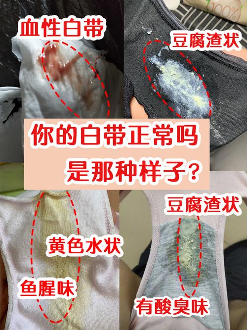 孕期白带会一直存在吗？不同阶段变化正常吗？需要关注哪些异常信号？-第3张图片-郑州医学网