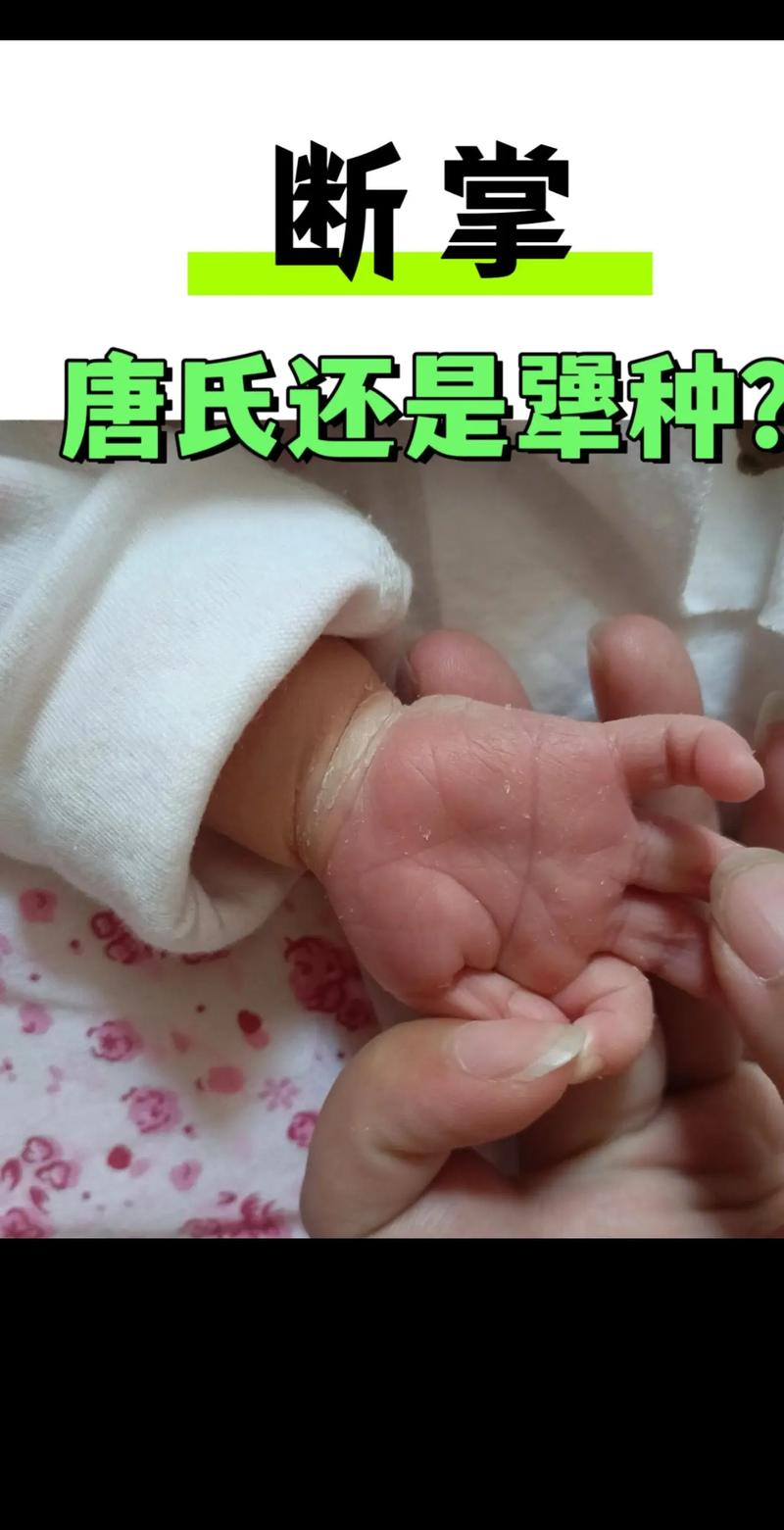 唐氏综合症新生儿有哪些典型表现？如何早期识别与干预？-第2张图片-郑州医学网