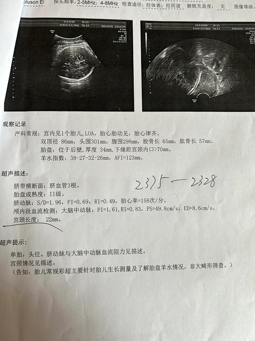 孕期如何及时发现小头畸形?产检能排查出胎儿头围异常吗?-第1张图片-郑州医学网 孕期如何及时发现小头畸形?产检能排查出胎儿头围异常吗?-第1张图片-郑州医学网