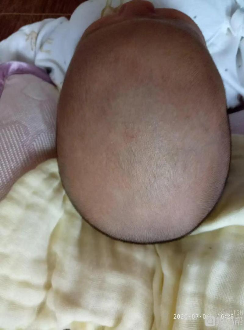 孕期如何及时发现小头畸形?产检能排查出胎儿头围异常吗?-第3张图片-郑州医学网 孕期如何及时发现小头畸形?产检能排查出胎儿头围异常吗?-第3张图片-郑州医学网