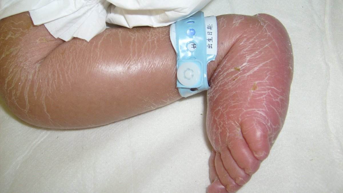 新生儿硬肿症的临床表现具体有哪些典型症状和体征？-第1张图片-郑州医学网