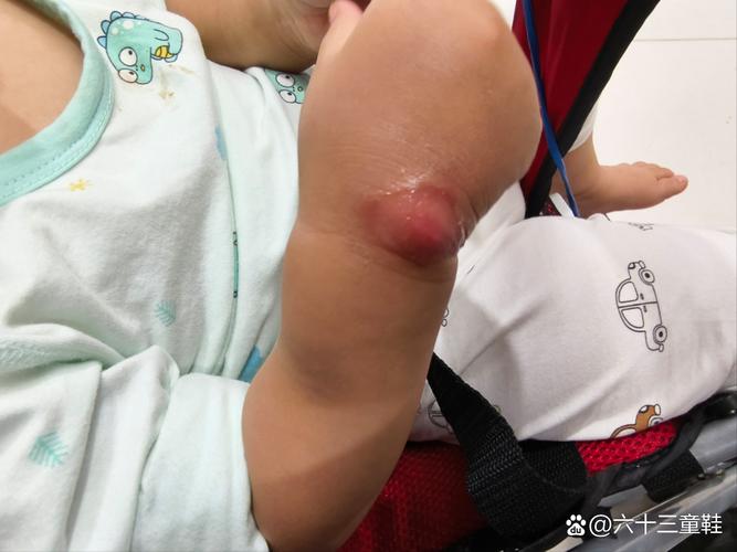 新生儿硬肿症的临床表现具体有哪些典型症状和体征？-第2张图片-郑州医学网