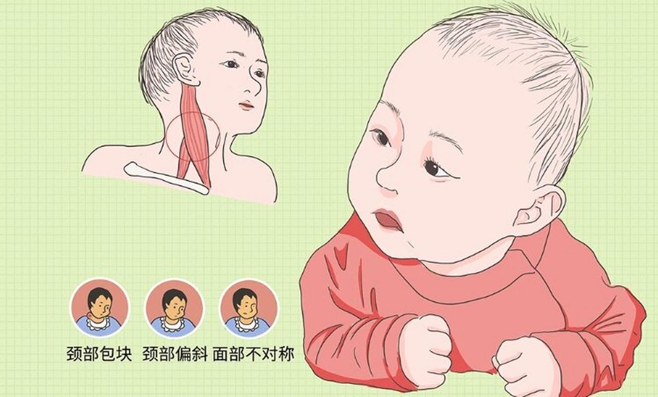 新生儿硬肿症的临床表现具体有哪些典型症状和体征？-第3张图片-郑州医学网