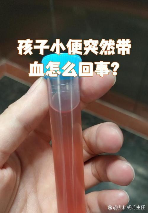 儿童孤立性血尿随访中，需警惕哪些潜在风险与干预时机？-第1张图片-郑州医学网