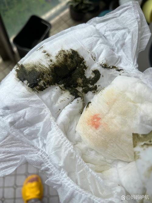 儿童孤立性血尿随访中，需警惕哪些潜在风险与干预时机？-第3张图片-郑州医学网