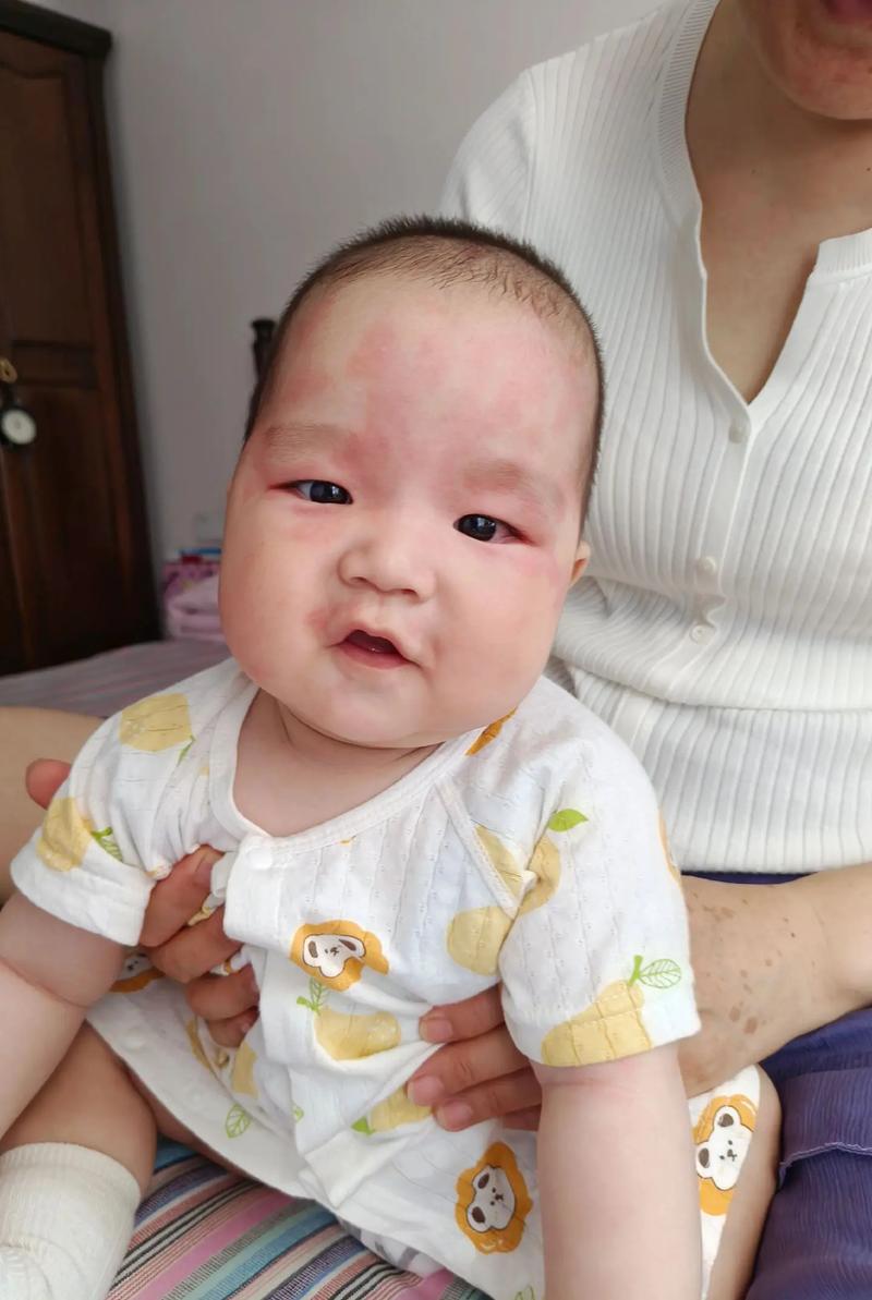 儿童吃鸡蛋过敏会出现哪些具体症状？如何区分与其他常见过敏反应？-第3张图片-郑州医学网