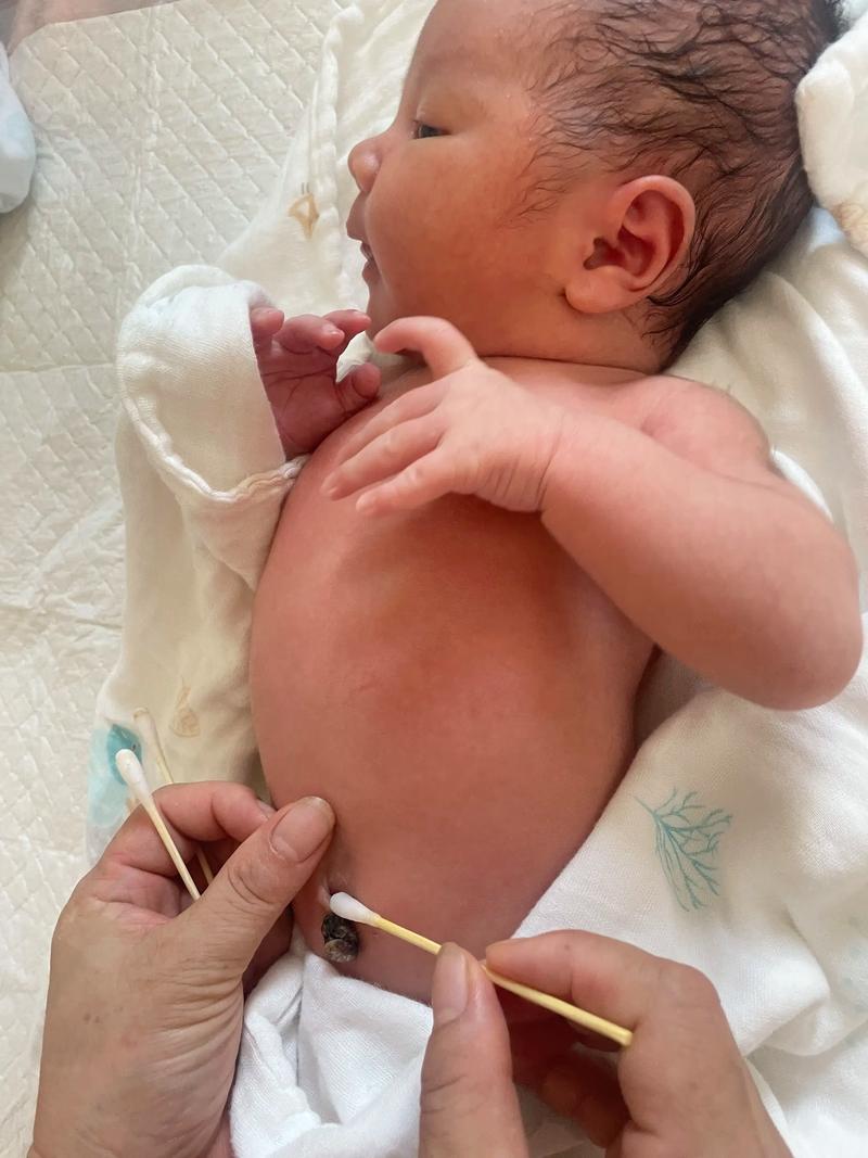 新生儿十二天肚脐还没掉，需要担心吗？正常脱落时间是什么时候？-第3张图片-郑州医学网