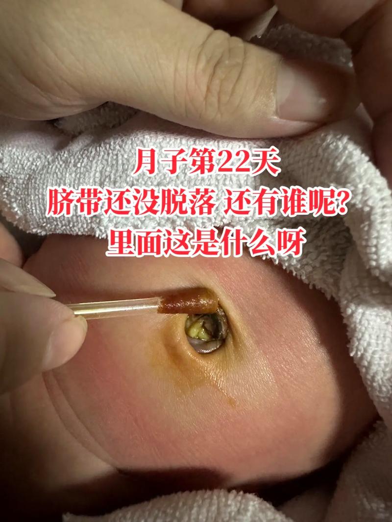 新生儿十二天肚脐还没掉，需要担心吗？正常脱落时间是什么时候？-第2张图片-郑州医学网