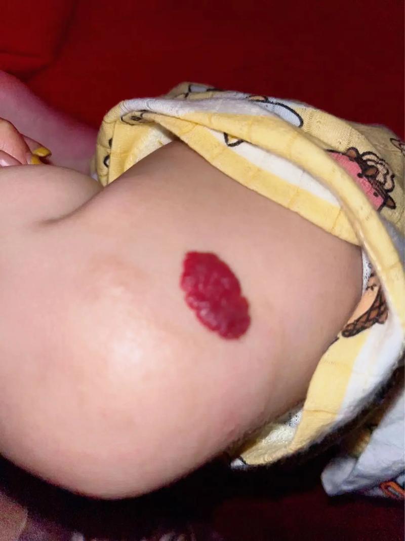 新生儿为何会长血管瘤？背后原因与家长该知道的真相是什么？-第3张图片-郑州医学网