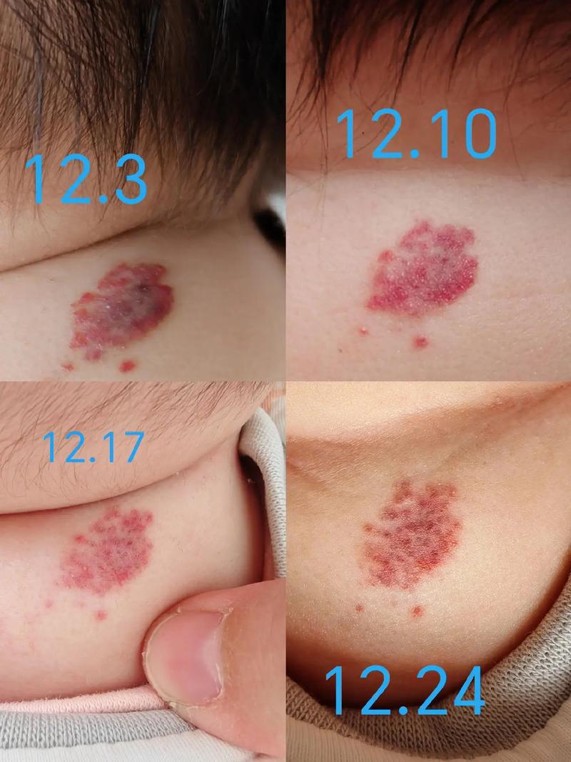 新生儿为何会长血管瘤?背后原因与家长该知道的真相是什么?-第2张图片-郑州医学网 新生儿为何会长血管瘤?背后原因与家长该知道的真相是什么?-第2张图片-郑州医学网