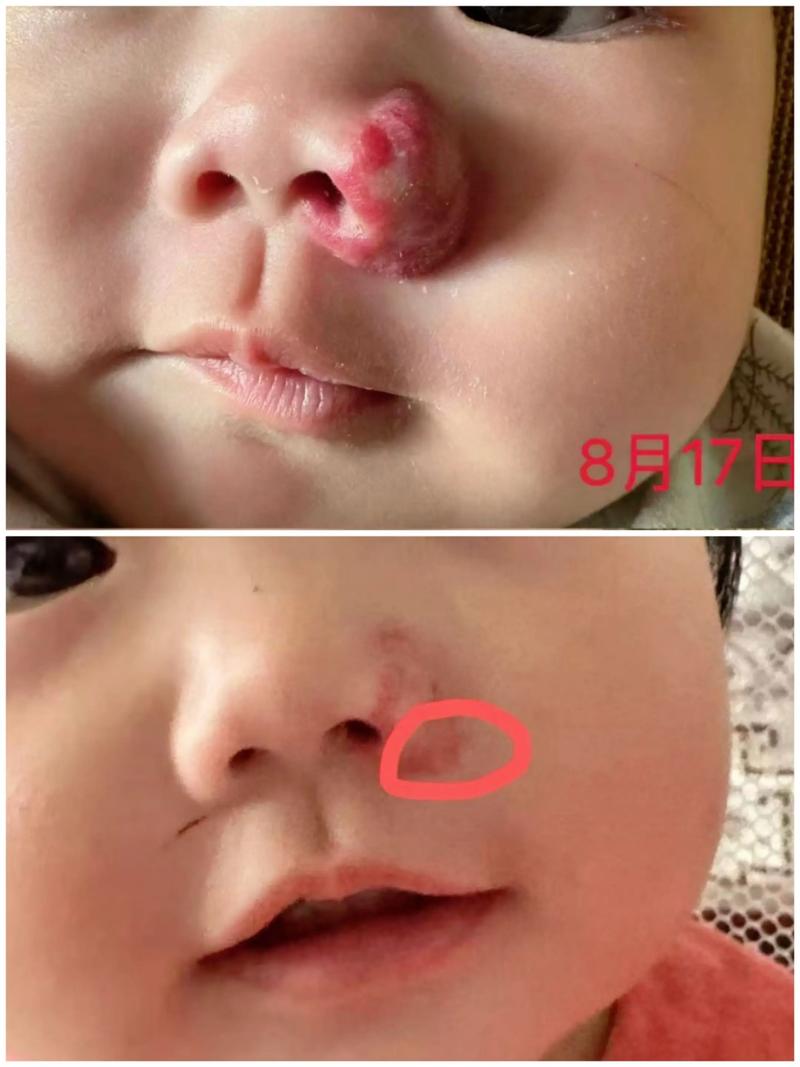 新生儿为何会长血管瘤?背后原因与家长该知道的真相是什么?-第1张图片-郑州医学网 新生儿为何会长血管瘤?背后原因与家长该知道的真相是什么?-第1张图片-郑州医学网