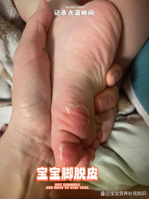 儿童手脚脱皮是缺乏维生素还是其他营养素？需如何针对性调理？-第2张图片-郑州医学网