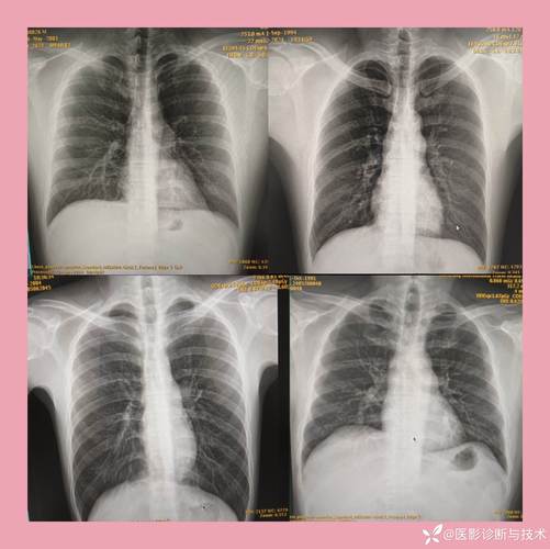 儿童肺动脉段突出究竟是什么原因导致的?-第2张图片-郑州医学网 儿童肺动脉段突出究竟是什么原因导致的?-第2张图片-郑州医学网