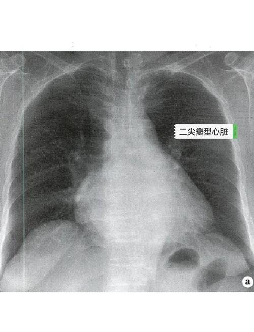 儿童肺动脉段突出究竟是什么原因导致的?-第1张图片-郑州医学网 儿童肺动脉段突出究竟是什么原因导致的?-第1张图片-郑州医学网