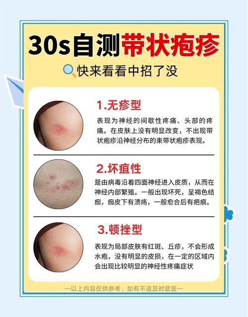 儿童带状疱疹怎么治？有哪些安全有效的治疗方案？-第2张图片-郑州医学网