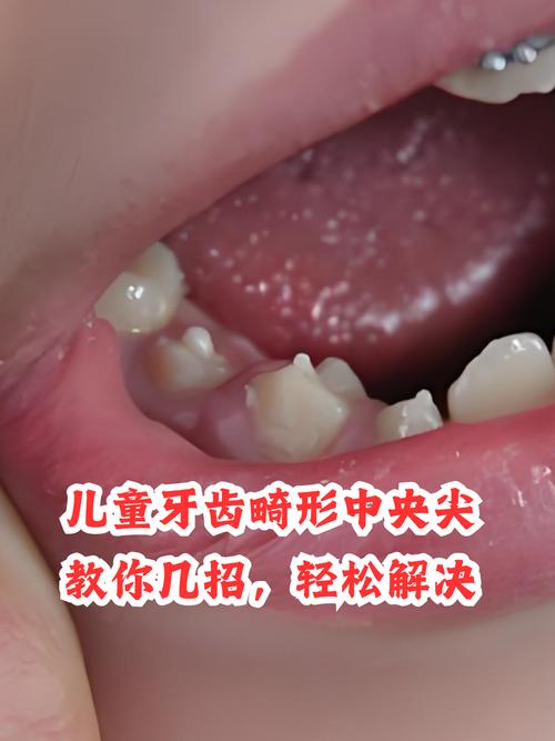 儿童换牙不齐怎么办？科瓦仁心如何科学干预？-第2张图片-郑州医学网