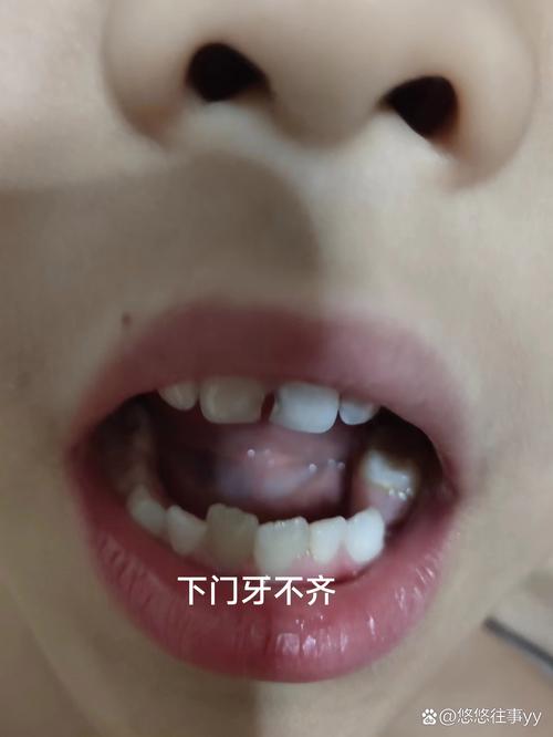 儿童换牙不齐怎么办？科瓦仁心如何科学干预？-第3张图片-郑州医学网