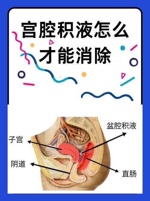 孕期宫腔积液排出图片，这是正常生理现象还是危险信号？-第1张图片-郑州医学网