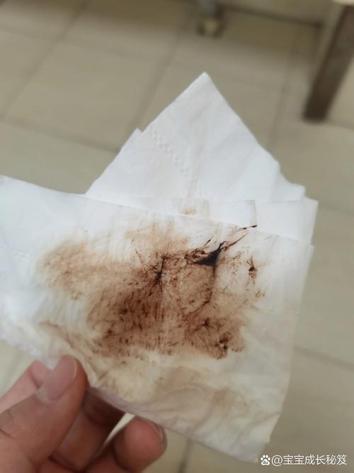 孕期宫腔积液排出图片，这是正常生理现象还是危险信号？-第2张图片-郑州医学网